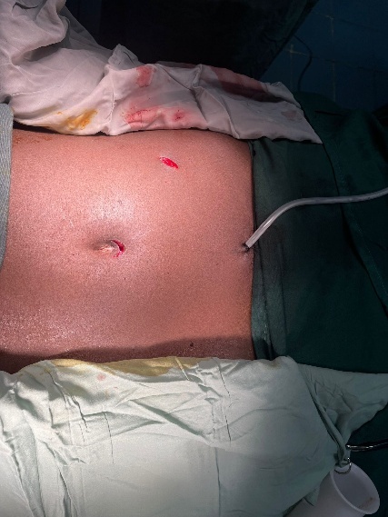 Photo showing small laparoscopic wounds